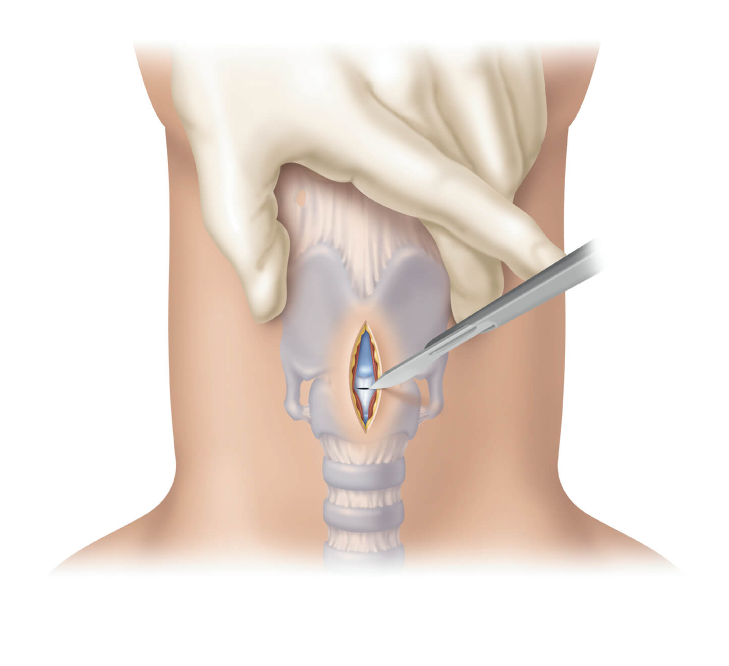 Airway Management – Surgical Cricothyrotomy